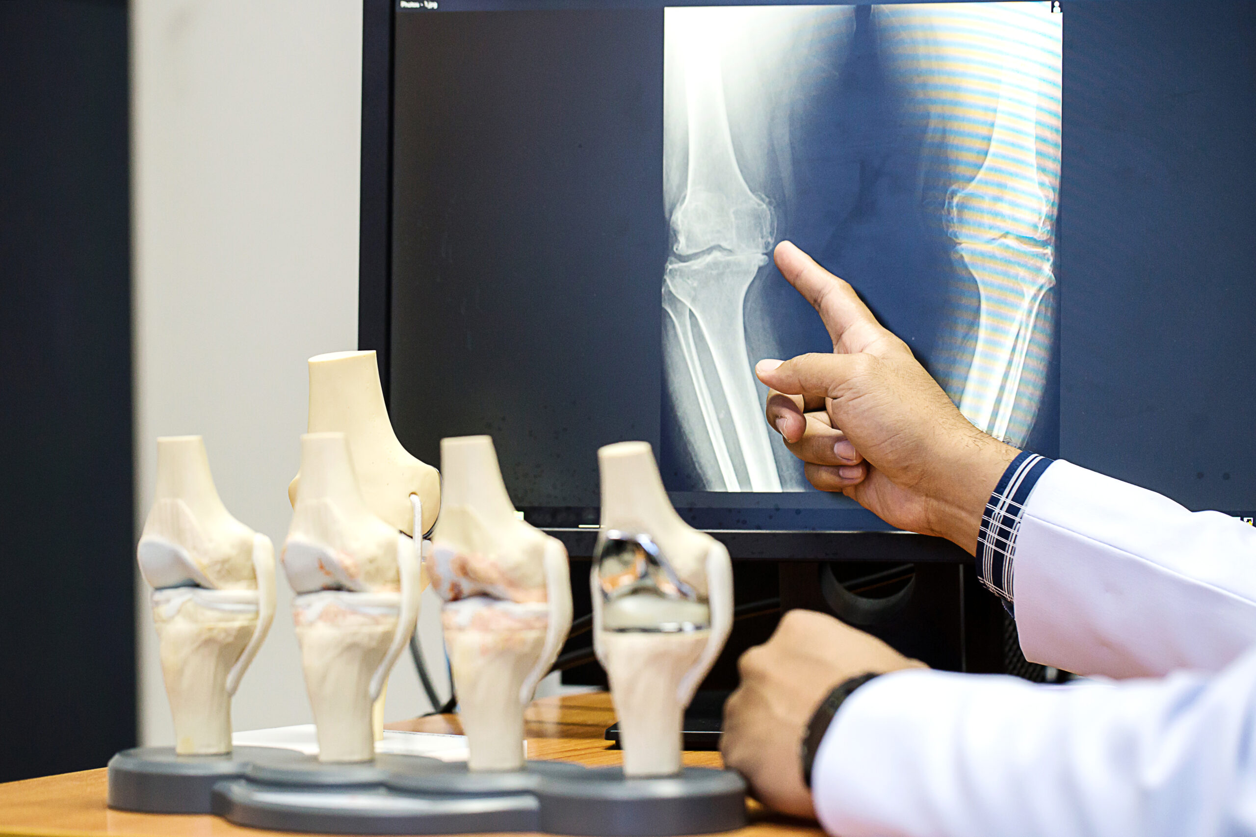 Doctor pointing on the knee problem point on x-ray film. x-ray film show skeleton knee on film. Surgery medical technology concept. Osteoarthritis in the elderly.
